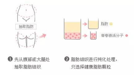 自体脂肪移植填充丰面颊怎么样