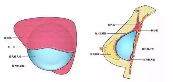 上海假体隆胸手术后会不会影响生活